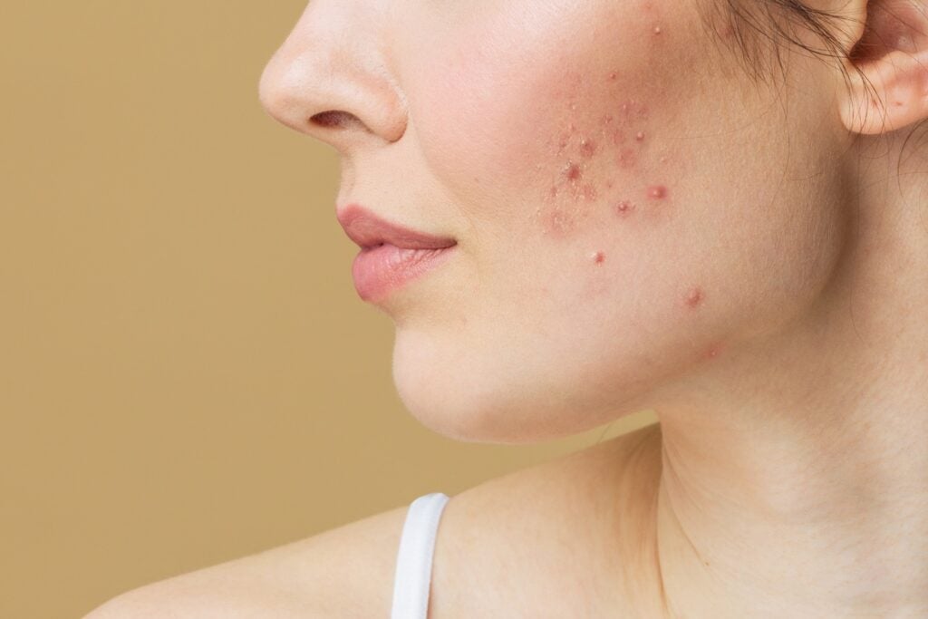 SkinCare MT Acne Treatment in Bozman