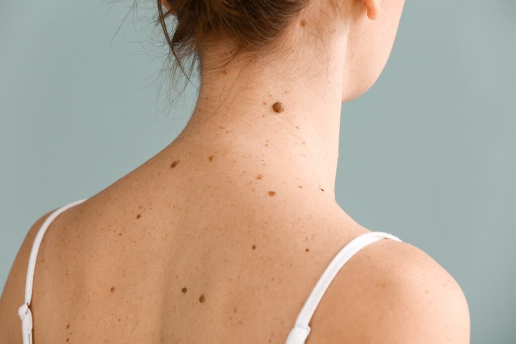 SkinCare MT Moles Treatment in Bozman