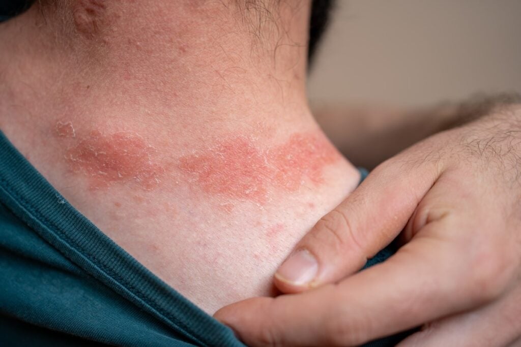 Psoriasis