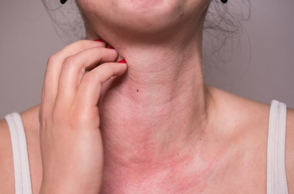 SkinCare MT Rashes Treatment in Bozman