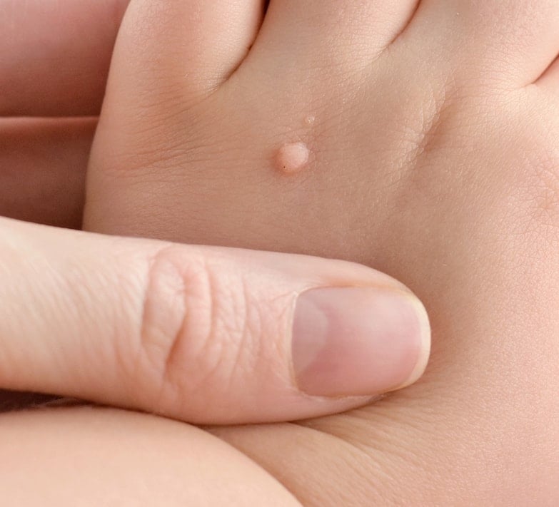 Pediatric Warts