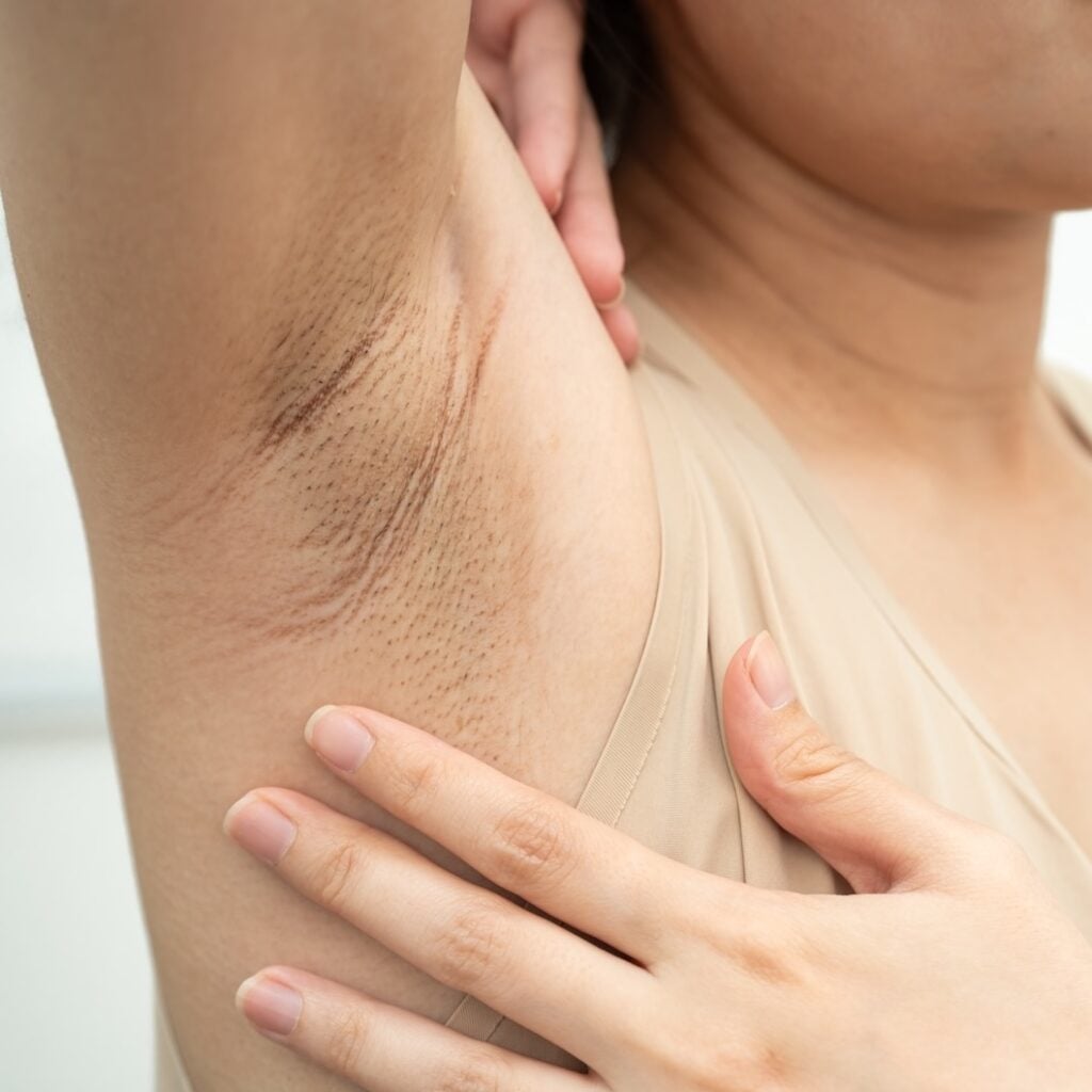 Hidradenitis Suppurativa Photo