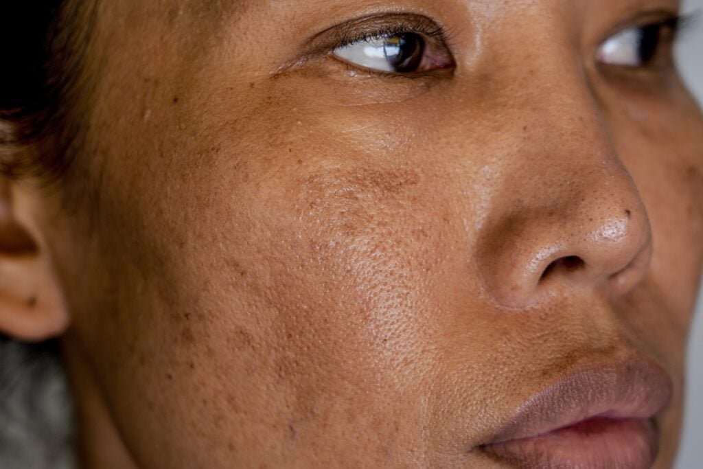 Melasma Face