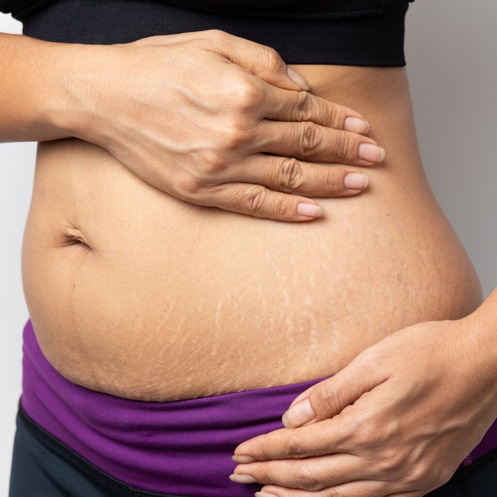 Stretch marks stomach